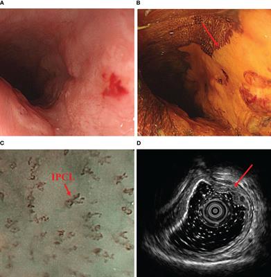 Thoracoscopic esophagectomy for thoracic esophageal cancer with right aortic arch and Kommerell diverticulum: a case report and literature review